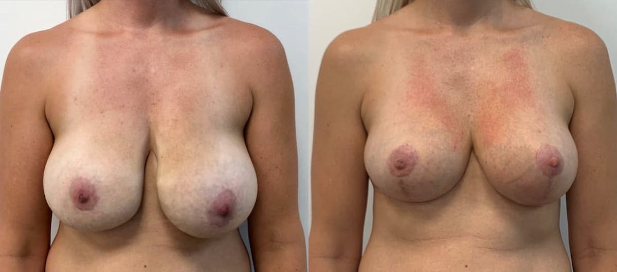 Breast Augmentation Before & After Gallery - Patient 403393 - Image 1