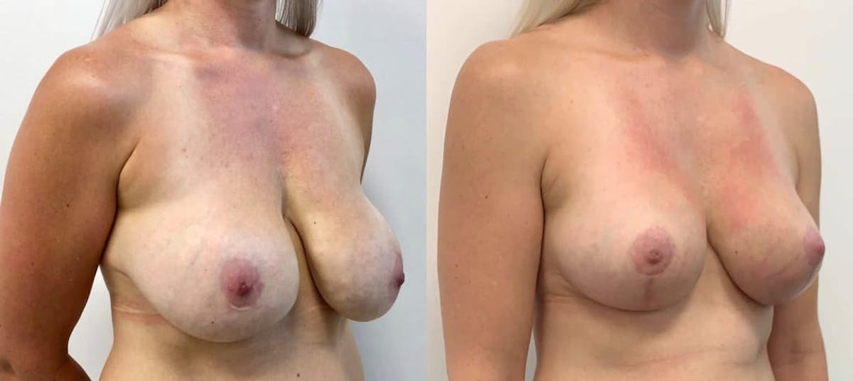 Breast Augmentation Before & After Gallery - Patient 403393 - Image 2