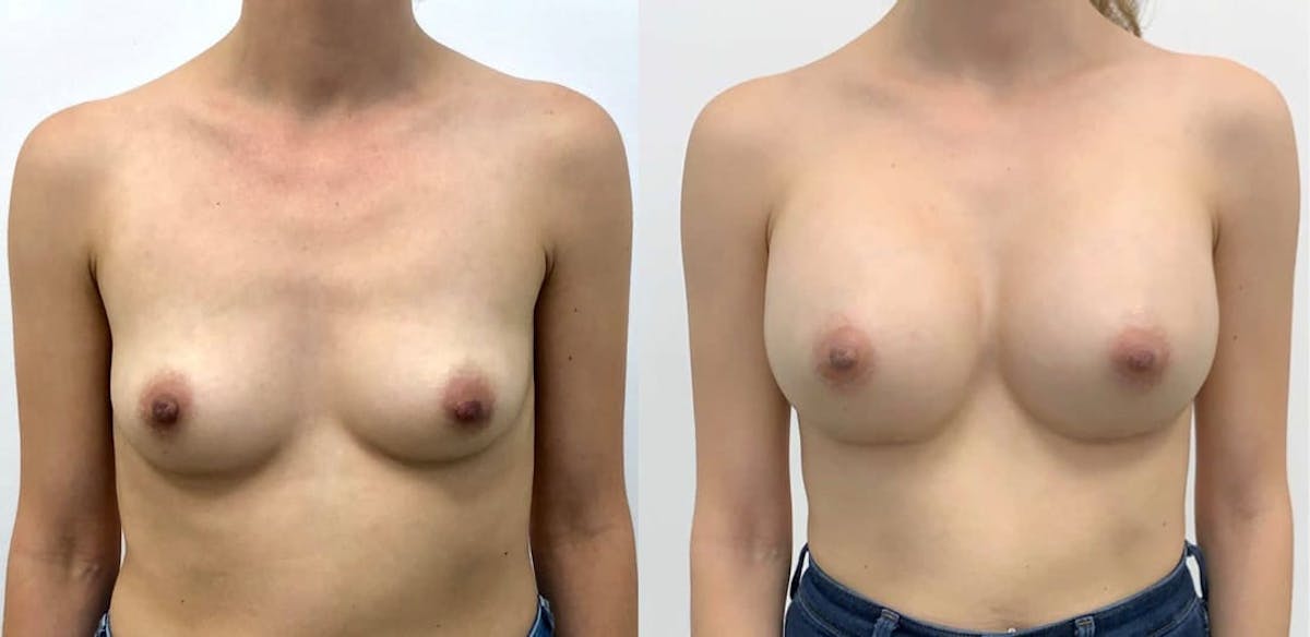 Breast Augmentation Before & After Gallery - Patient 198191 - Image 1
