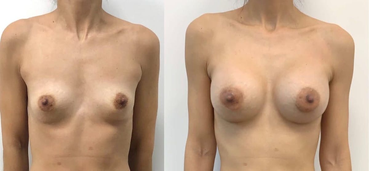 Breast Augmentation Before & After Gallery - Patient 295791 - Image 1