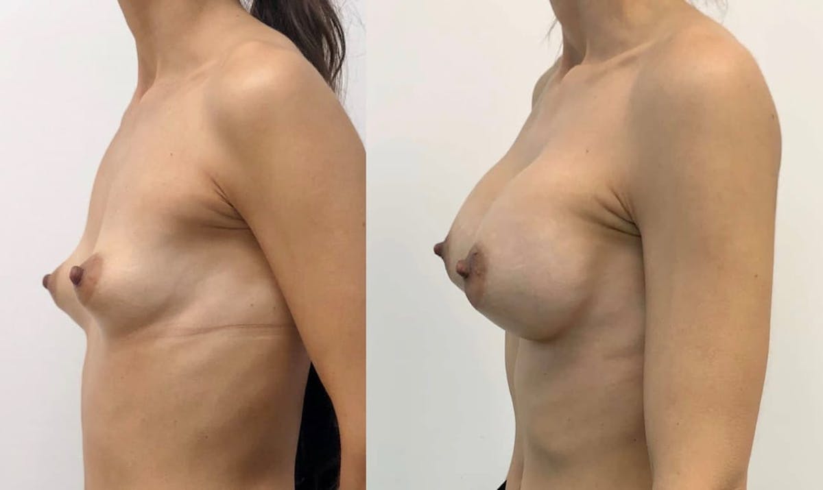 Breast Augmentation Before & After Gallery - Patient 295791 - Image 2