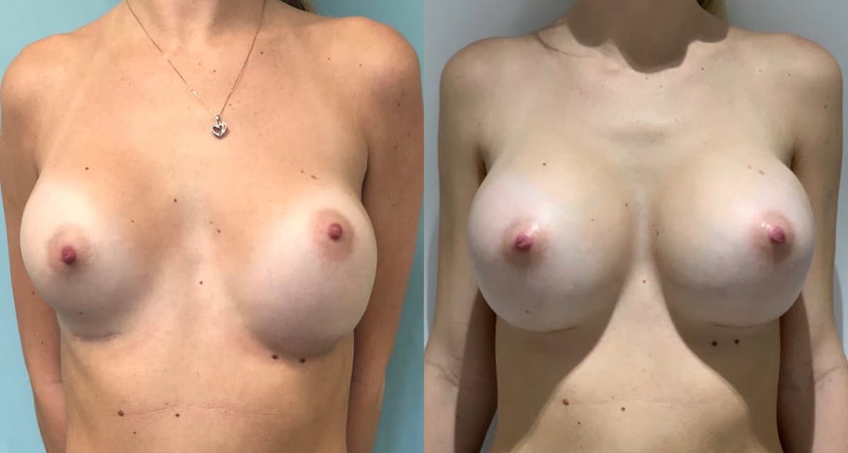 Breast Augmentation Before & After Gallery - Patient 126732 - Image 1