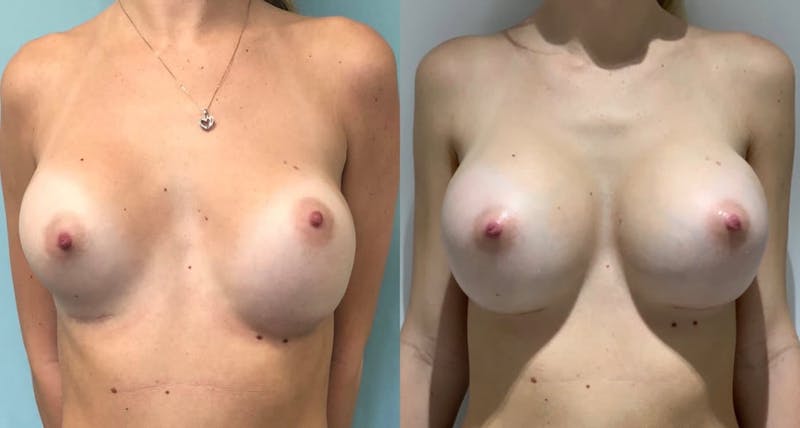 Breast Augmentation Before & After Gallery - Patient 126732 - Image 1