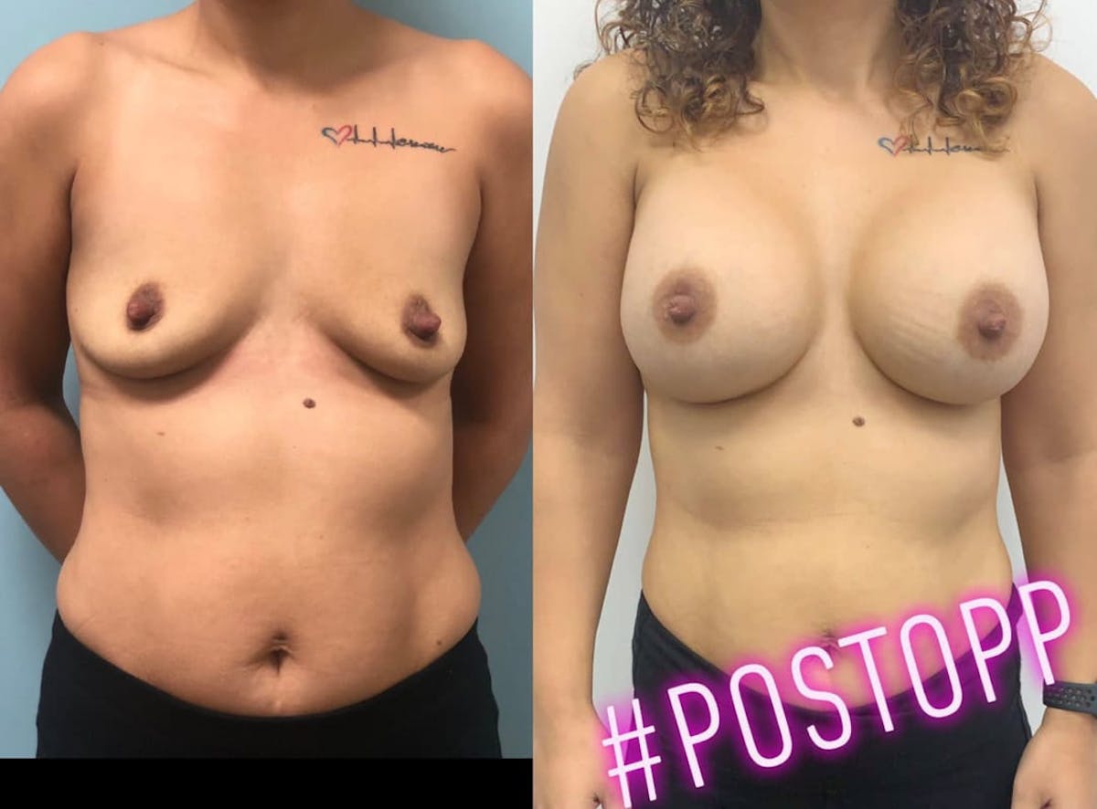 Breast Augmentation Before & After Gallery - Patient 388771 - Image 1