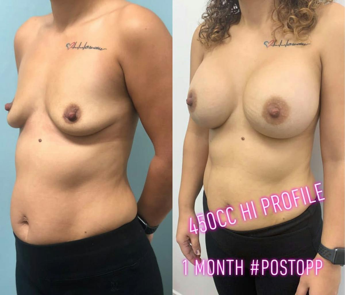 Breast Augmentation Before & After Gallery - Patient 388771 - Image 2