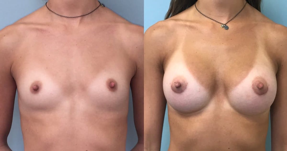 Breast Augmentation Before & After Gallery - Patient 425050 - Image 1