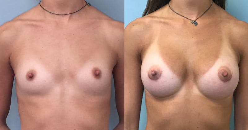 Breast Augmentation Before & After Gallery - Patient 425050 - Image 1