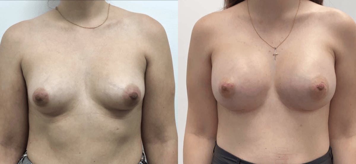 Breast Augmentation Before & After Gallery - Patient 152988 - Image 1