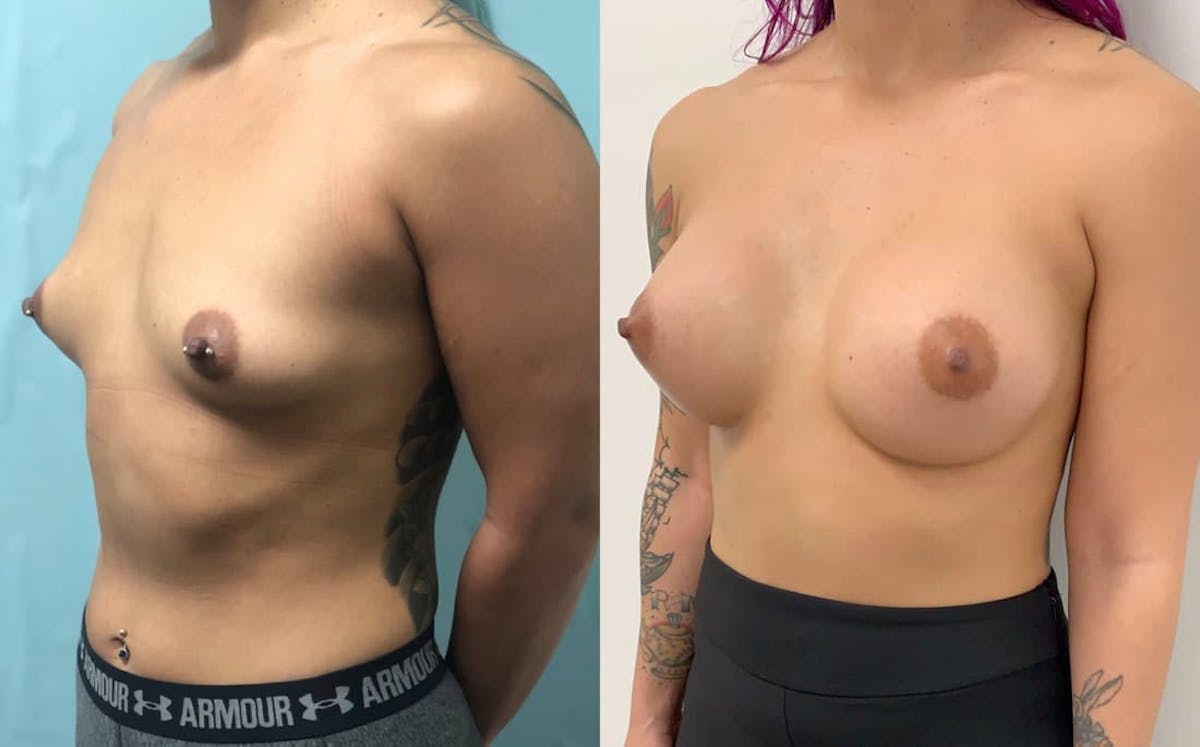 Breast Augmentation Before & After Gallery - Patient 308588 - Image 2