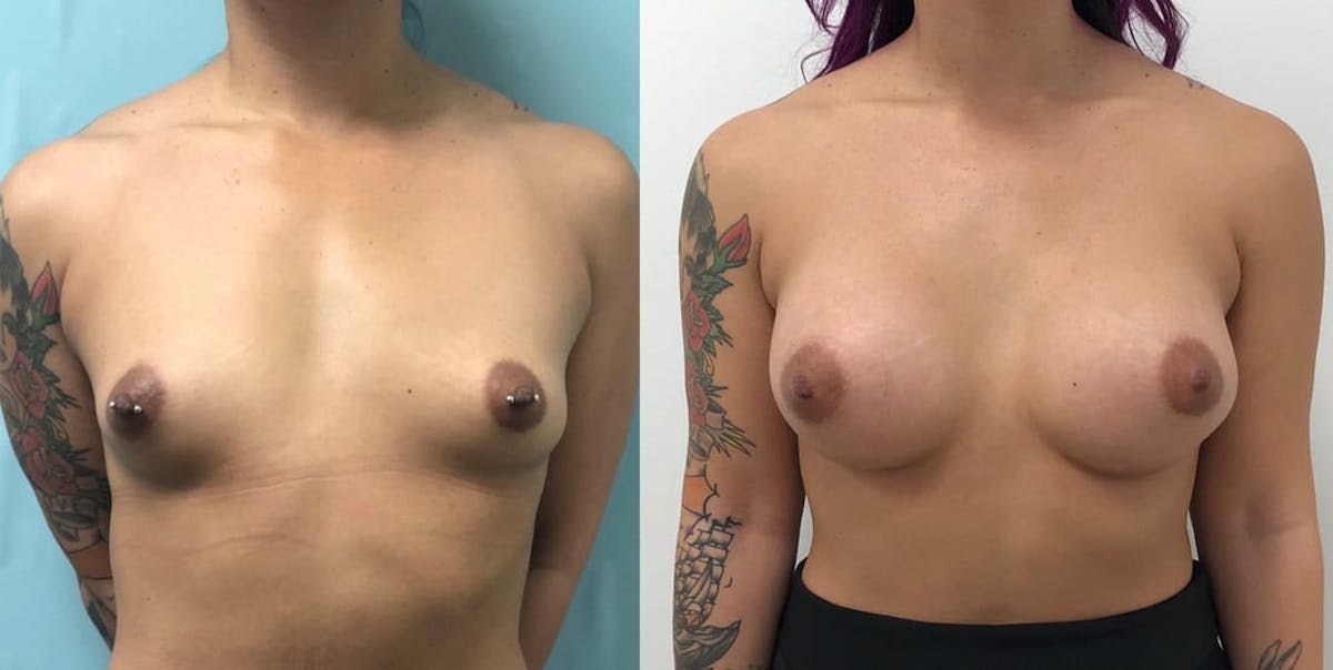 Breast Augmentation Before & After Gallery - Patient 308588 - Image 1