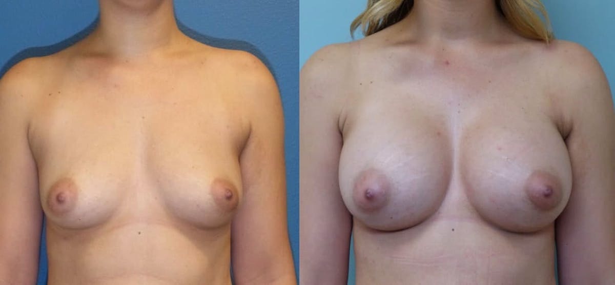 Breast Augmentation Before & After Gallery - Patient 877416 - Image 1