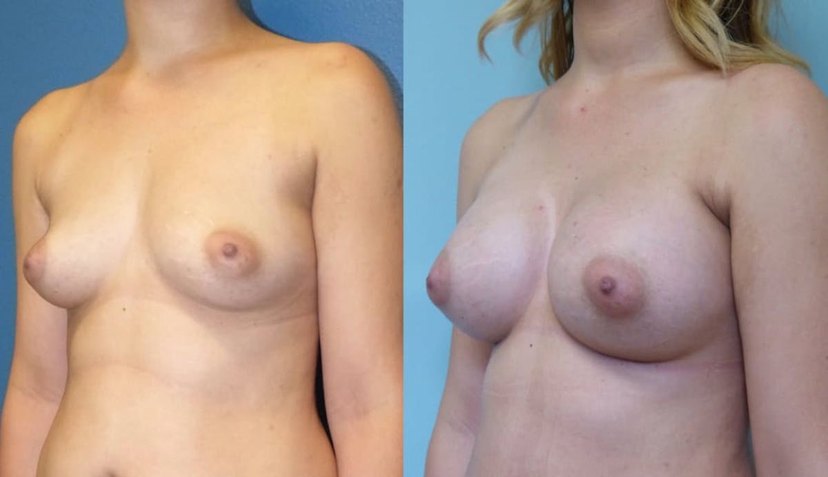 Breast Augmentation Before & After Gallery - Patient 877416 - Image 2
