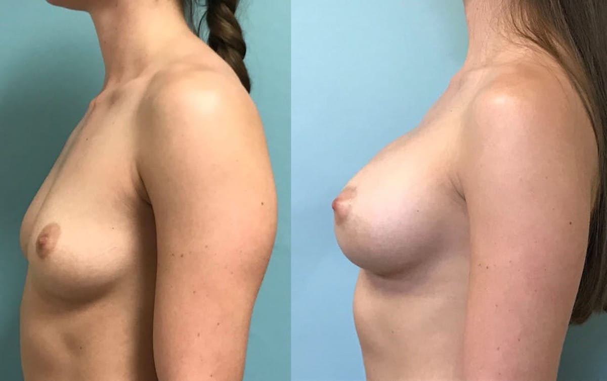 Breast Augmentation Before & After Gallery - Patient 133567 - Image 2