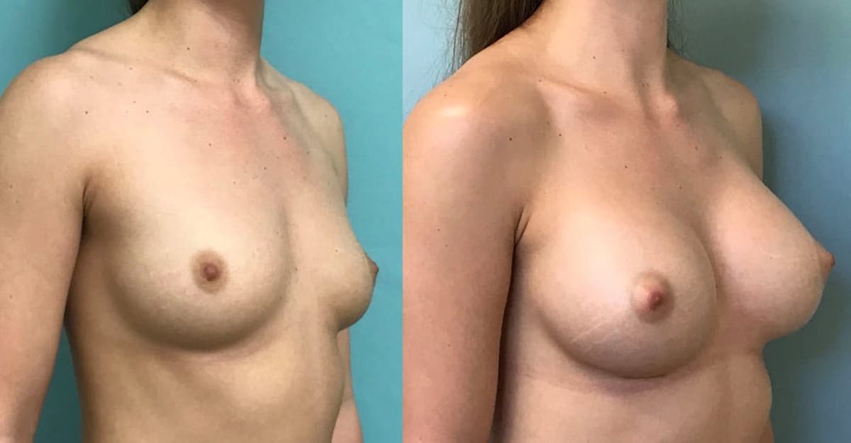 Breast Augmentation Before & After Gallery - Patient 133567 - Image 3