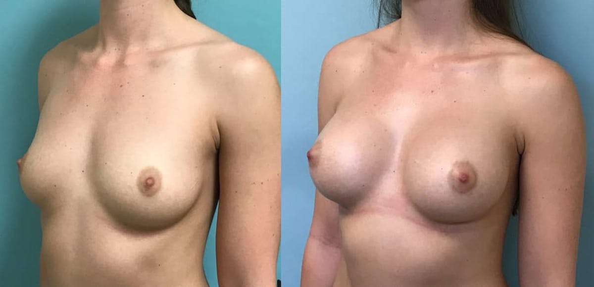 Breast Augmentation Before & After Gallery - Patient 133567 - Image 1