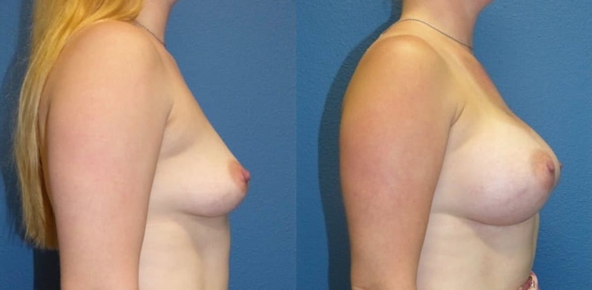 Breast Augmentation Before & After Gallery - Patient 644157 - Image 1