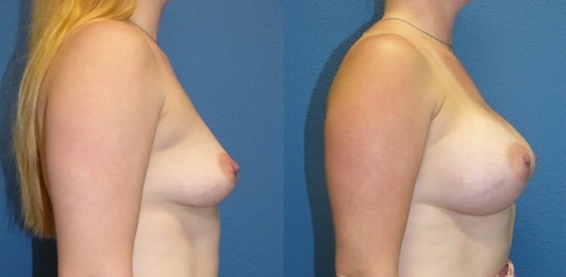 Breast Augmentation Before & After Gallery - Patient 644157 - Image 1
