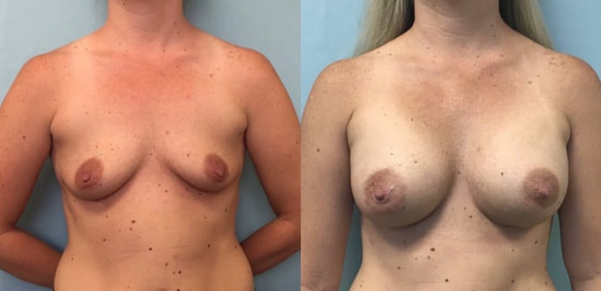 Breast Augmentation Before & After Gallery - Patient 109815 - Image 1