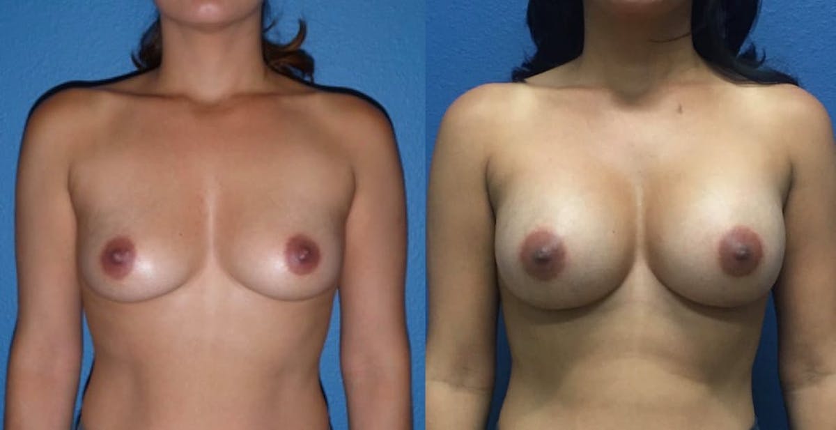 Breast Augmentation Before & After Gallery - Patient 385909 - Image 1