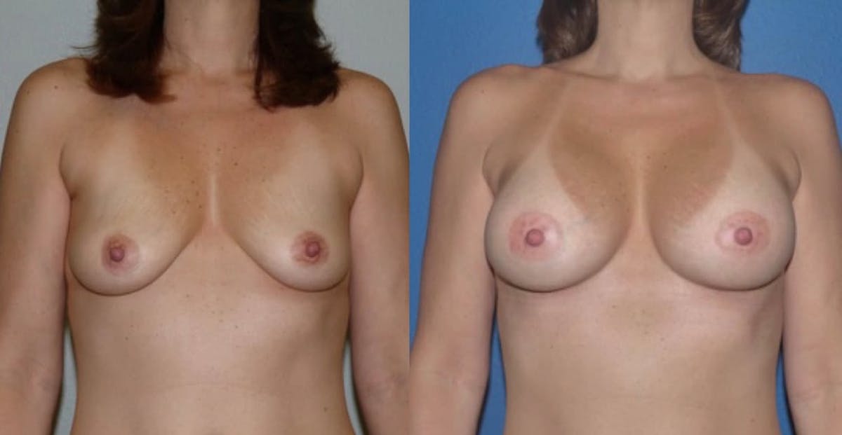 Breast Augmentation Before & After Gallery - Patient 263708 - Image 1