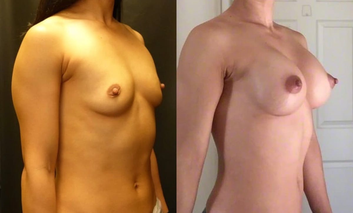 Breast Augmentation Before & After Gallery - Patient 350229 - Image 1