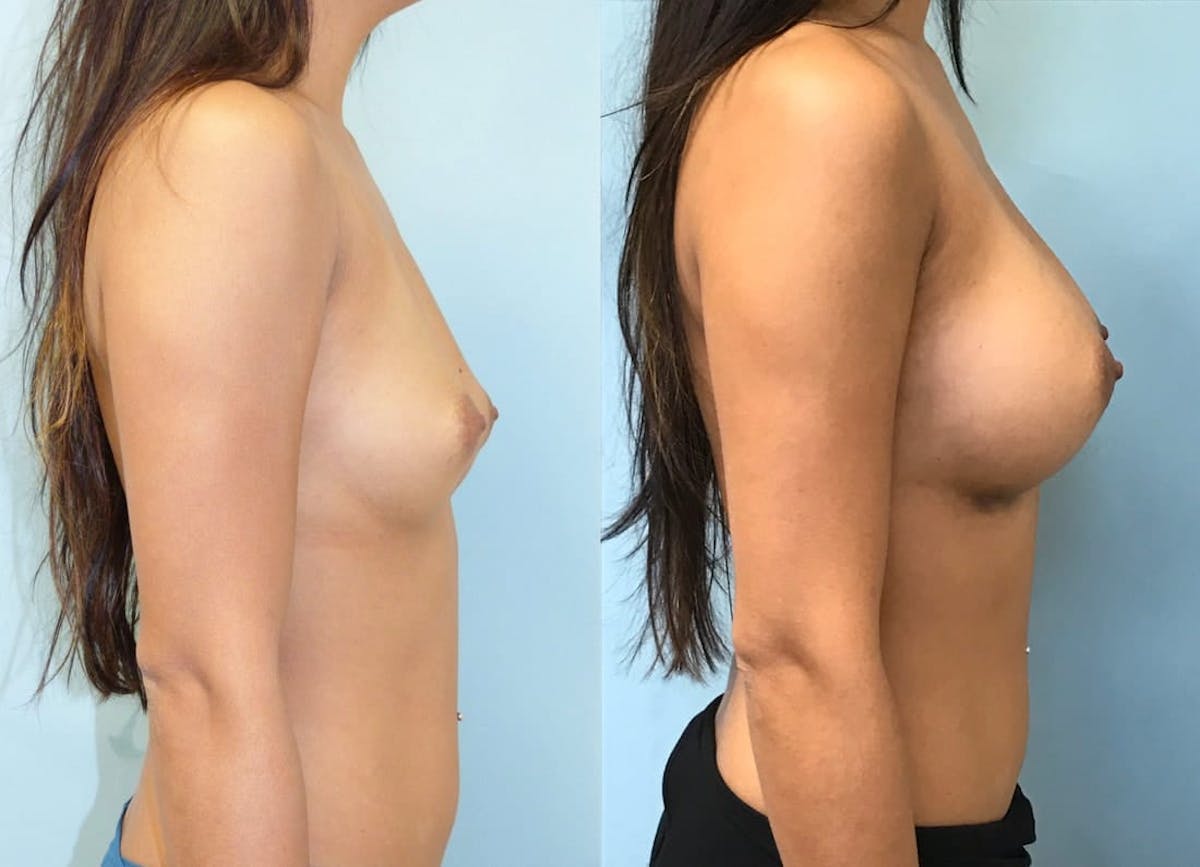 Breast Augmentation Before & After Gallery - Patient 271051 - Image 1