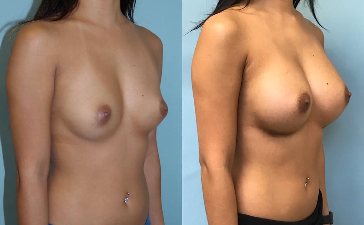 Breast Augmentation Before & After Gallery - Patient 271051 - Image 2
