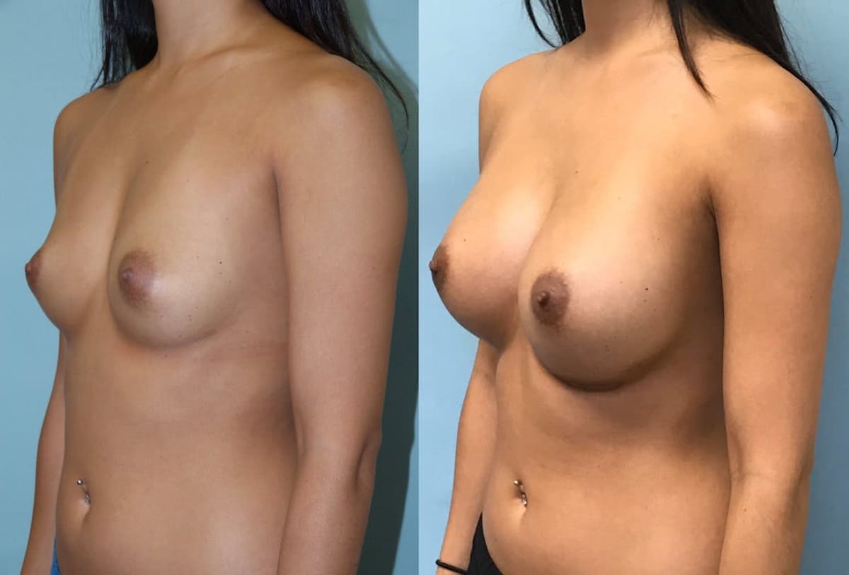 Breast Augmentation Before & After Gallery - Patient 271051 - Image 3