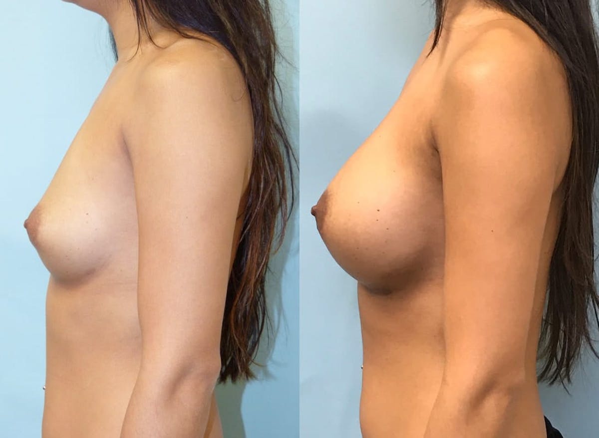 Breast Augmentation Before & After Gallery - Patient 271051 - Image 4
