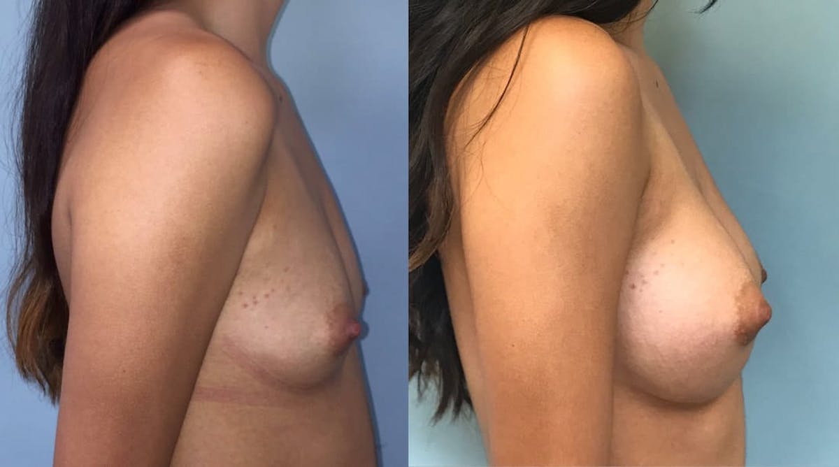 Breast Augmentation Before & After Gallery - Patient 355743 - Image 1