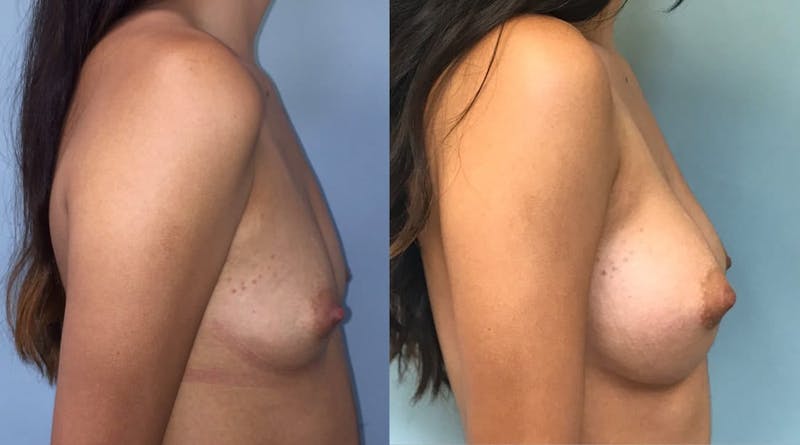 Breast Augmentation Before & After Gallery - Patient 355743 - Image 1