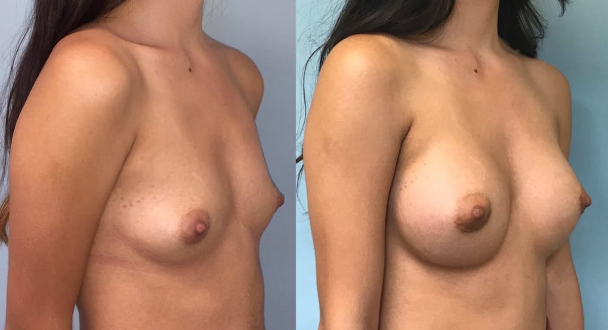Breast Augmentation Before & After Gallery - Patient 355743 - Image 2