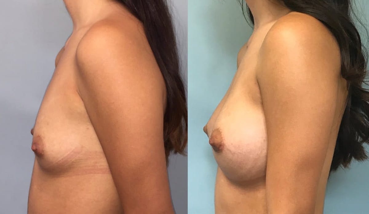 Breast Augmentation Before & After Gallery - Patient 355743 - Image 3