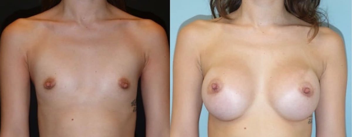 Breast Augmentation Before & After Gallery - Patient 367759 - Image 1