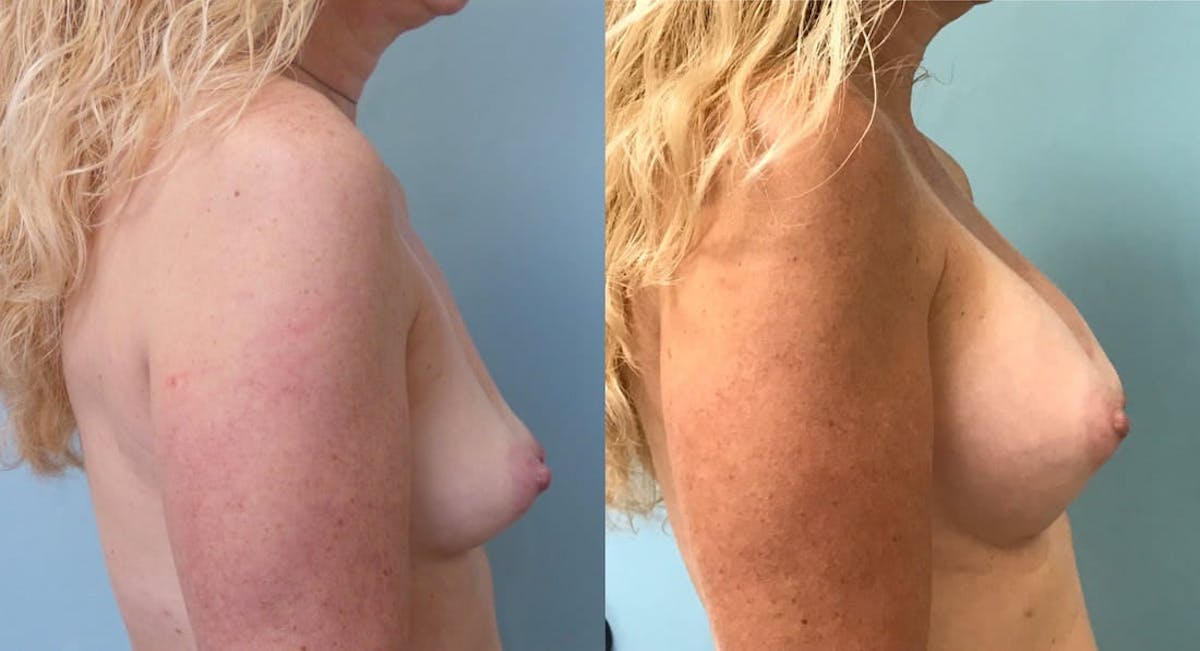 Breast Augmentation Before & After Gallery - Patient 160224 - Image 1