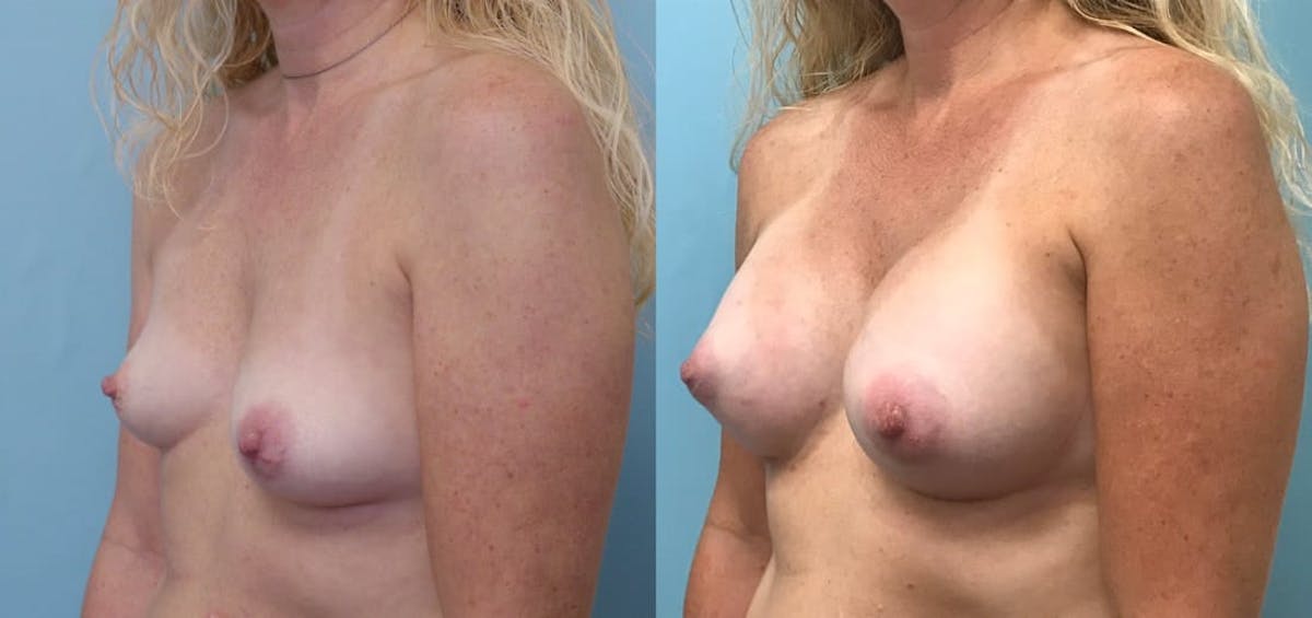 Breast Augmentation Before & After Gallery - Patient 160224 - Image 2