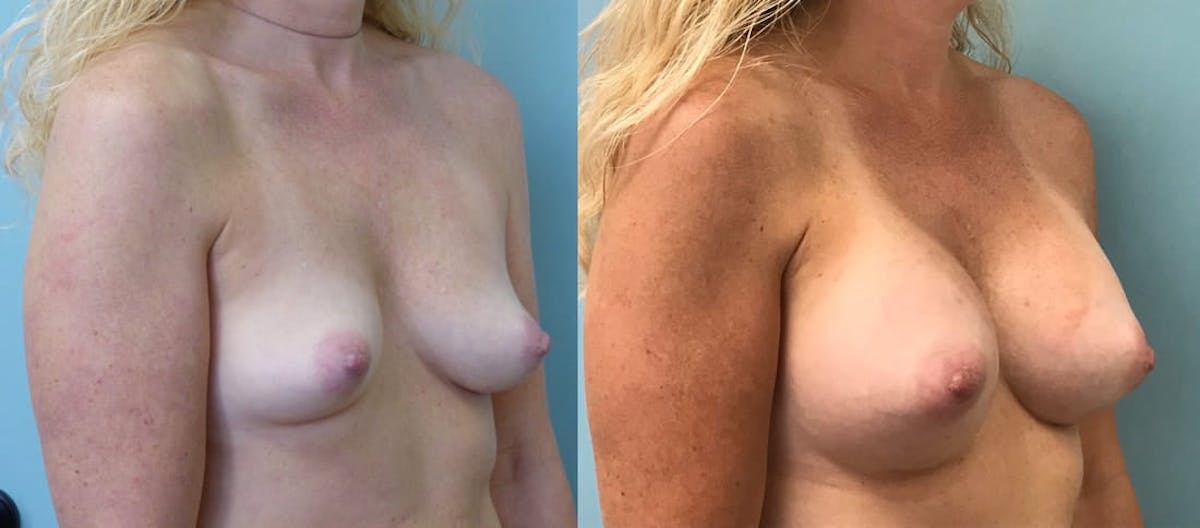 Breast Augmentation Before & After Gallery - Patient 160224 - Image 3