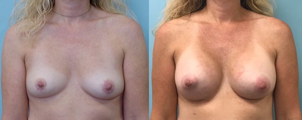 Breast Augmentation Before & After Gallery - Patient 160224 - Image 4