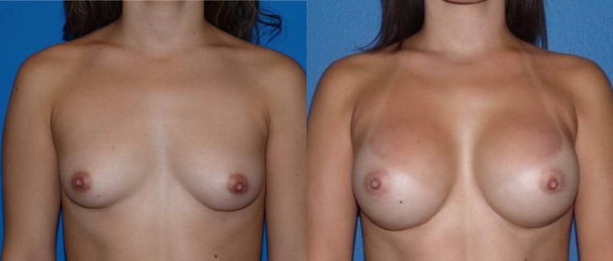 Breast Augmentation Before & After Gallery - Patient 399578 - Image 2