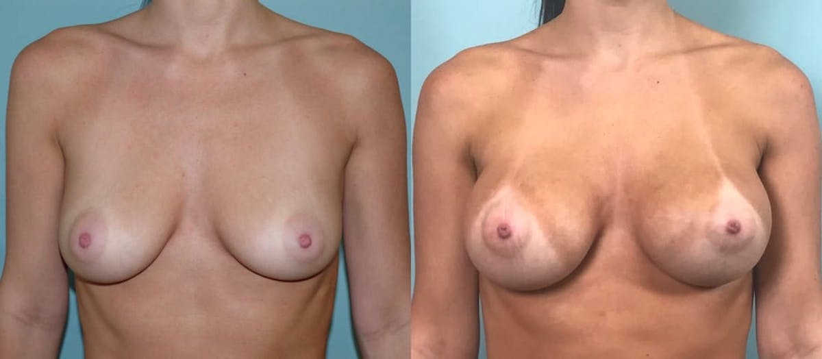 Breast Augmentation Before & After Gallery - Patient 302035 - Image 1