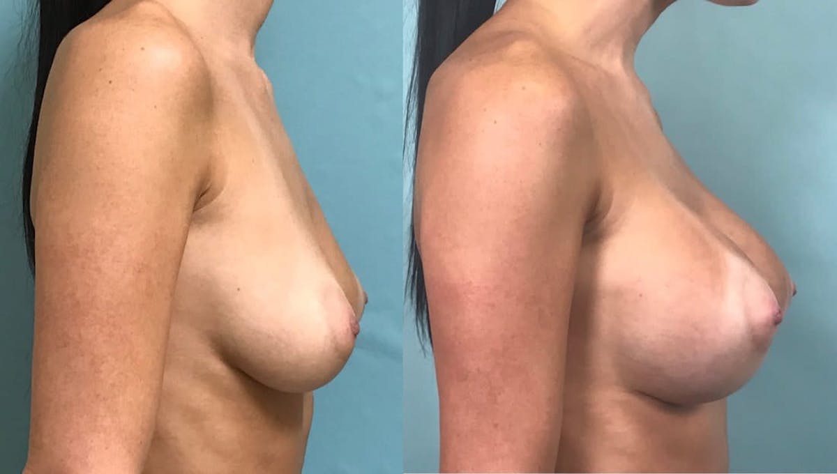 Breast Augmentation Before & After Gallery - Patient 302035 - Image 2