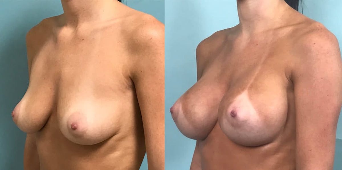 Breast Augmentation Before & After Gallery - Patient 302035 - Image 3