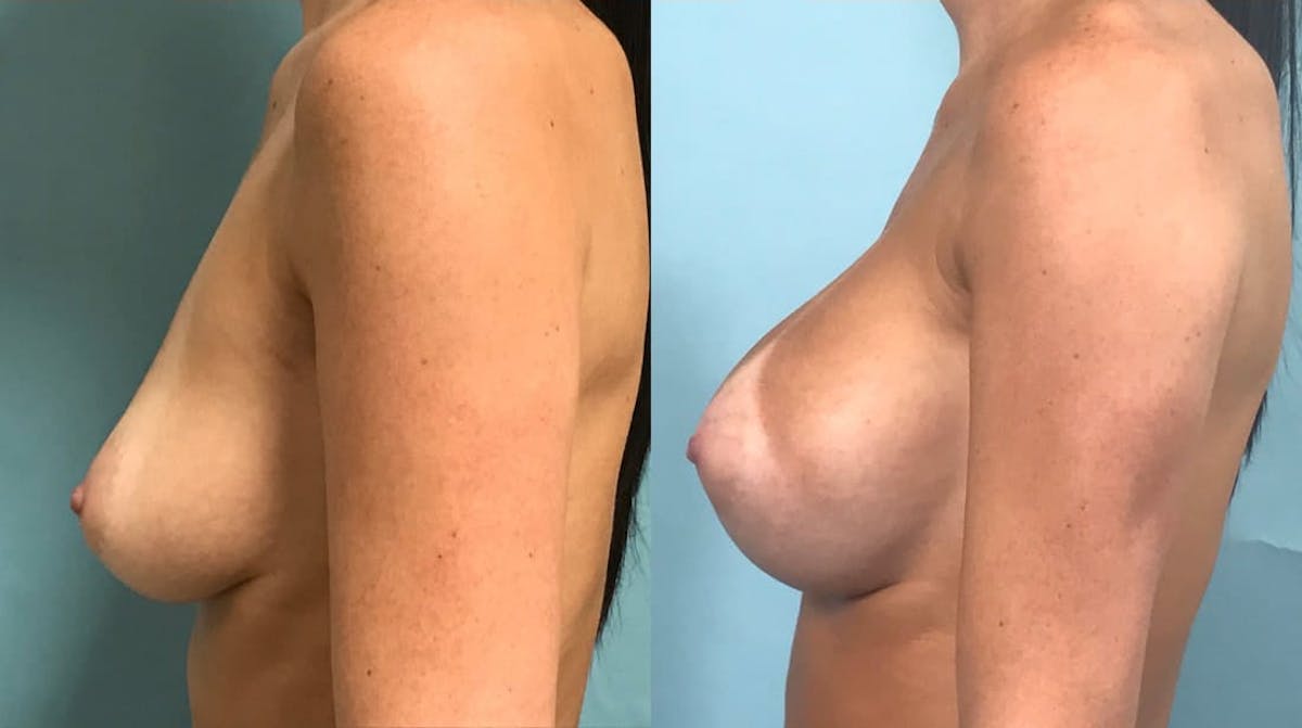 Breast Augmentation Before & After Gallery - Patient 302035 - Image 4