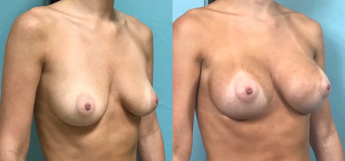 Breast Augmentation Before & After Gallery - Patient 302035 - Image 5