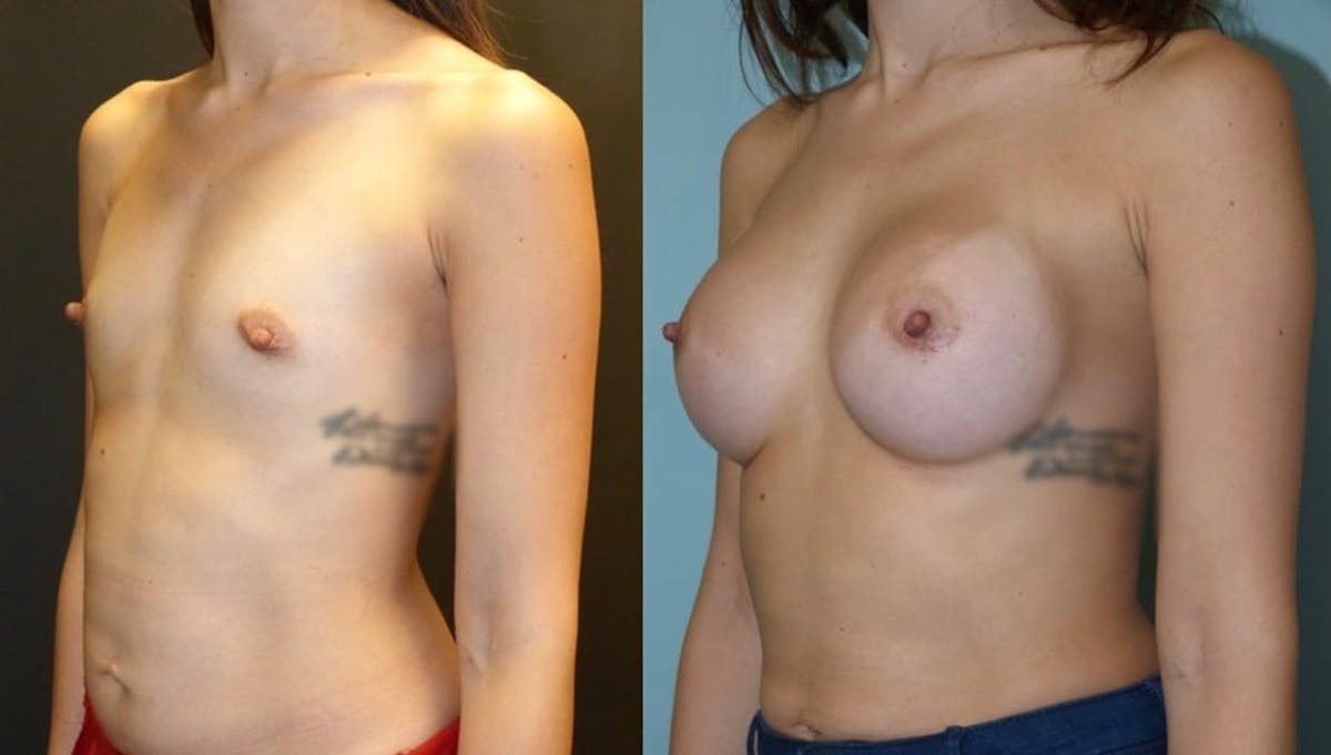 Breast Augmentation Before & After Gallery - Patient 422615 - Image 1