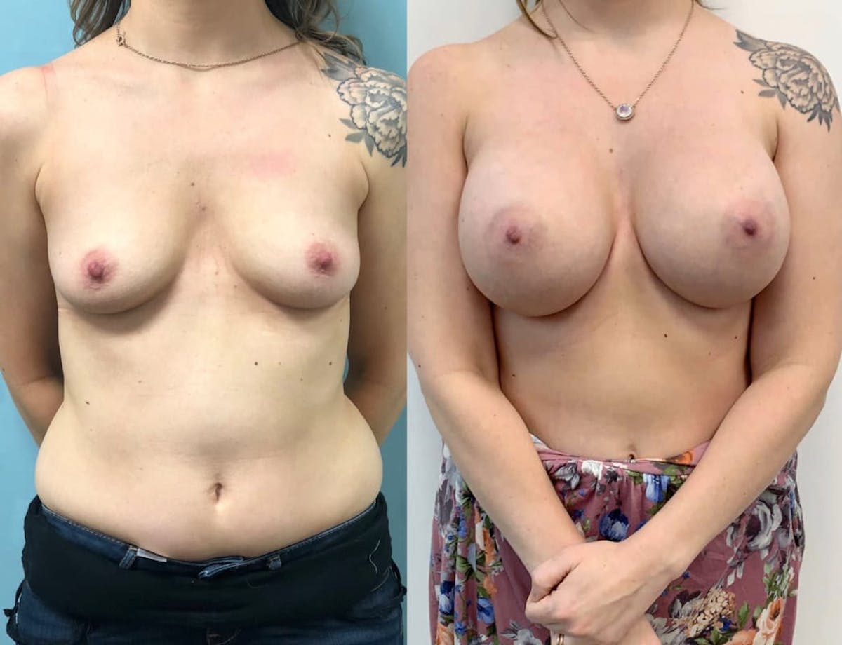Breast Augmentation Before & After Gallery - Patient 339085 - Image 1