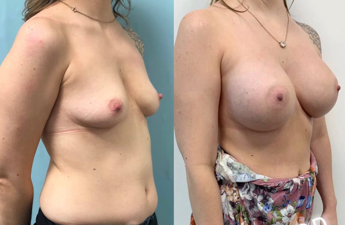 Breast Augmentation Before & After Gallery - Patient 339085 - Image 2