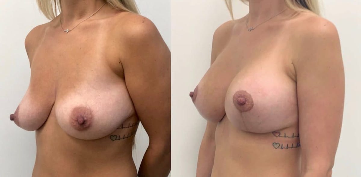 Breast Augmentation Before & After Gallery - Patient 376871 - Image 1