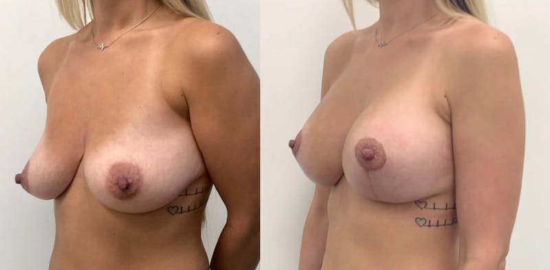 Breast Augmentation Before & After Gallery - Patient 376871 - Image 1