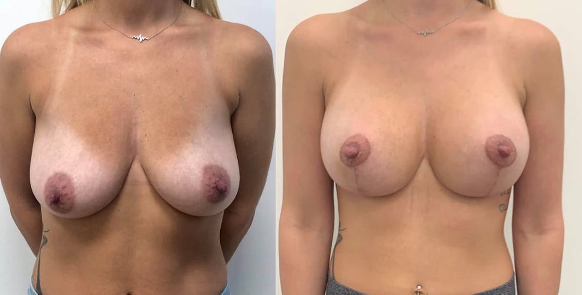 Breast Augmentation Before & After Gallery - Patient 376871 - Image 2